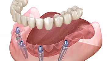 Illustration of all-on-4 implant dentures