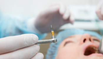 Dental implant surgery is where your dental implant is permanently inserted into your jaw