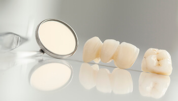 Fixed bridges and dental exam mirror