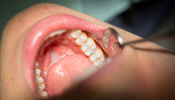 Dentist examining sealed teeth