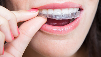 Woman putting an Invisalign clear aligner in Danville into her mouth