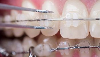 Close up of teeth with braces in Danville