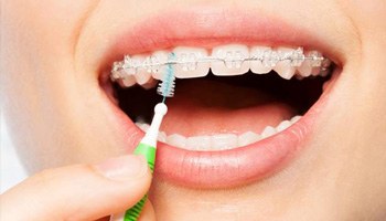 Person using an interdental brush to clean their braces