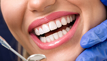 Close up of the smile of a person with veneers in Danville