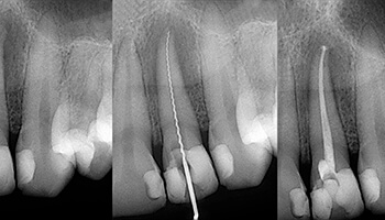 X ray of the teeth before and after root canal treatment