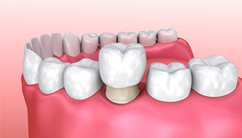 Animated dental crown in Danville being placed over a tooth