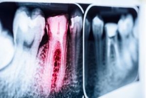 Inflamed tooth on an x-ray