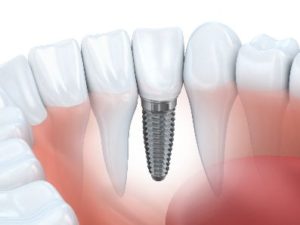 Model of an implant in the lower jaw