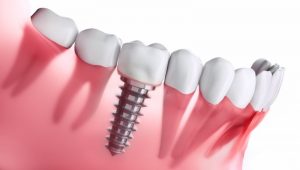 Implant and regular teeth