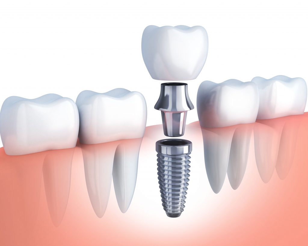 implant diagram Danville Dental Associates Blog